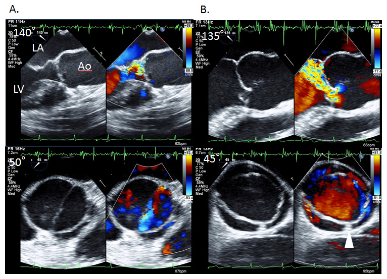 大動脈弁逆流の原因とその病態 | 「心臓」特別号「弁膜症 大動脈弁狭窄