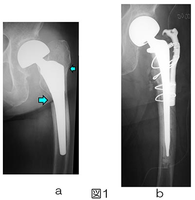 人工関節周囲骨折｜一般社団法人 日本整形外傷学会 骨折の解説