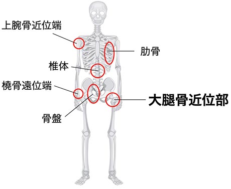 大腿骨頚部骨折と大腿骨転子部骨折｜一般社団法人 日本整形外傷学会