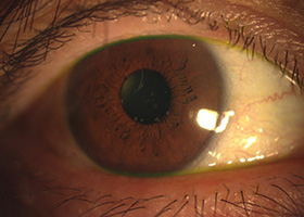 PTK治療的表層角膜切除術（エキシマレーザーによるもの）｜治療と手術