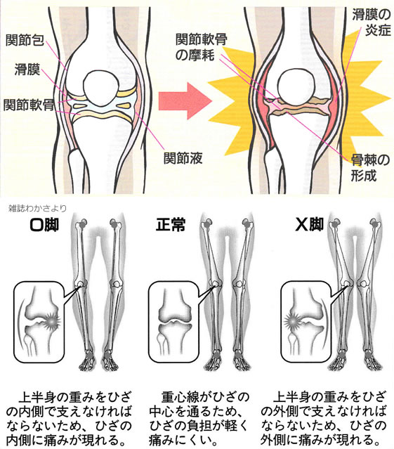 変形性膝関節症 | 整形外科の病気 | どうやリハビリ整形外科