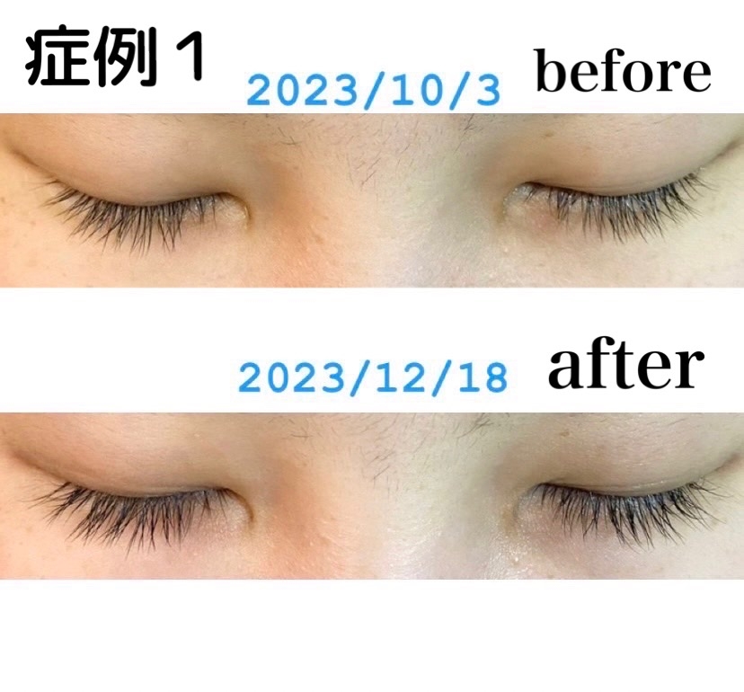 まつ毛美容液：医療脱毛・自由診療：自由診療｜泉佐野おかざき