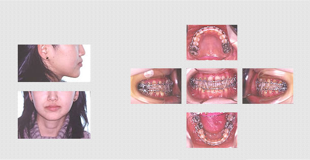 顔面非対称の矯正治療・症例｜外科的治療｜恵佑会矯正歯科クリニック