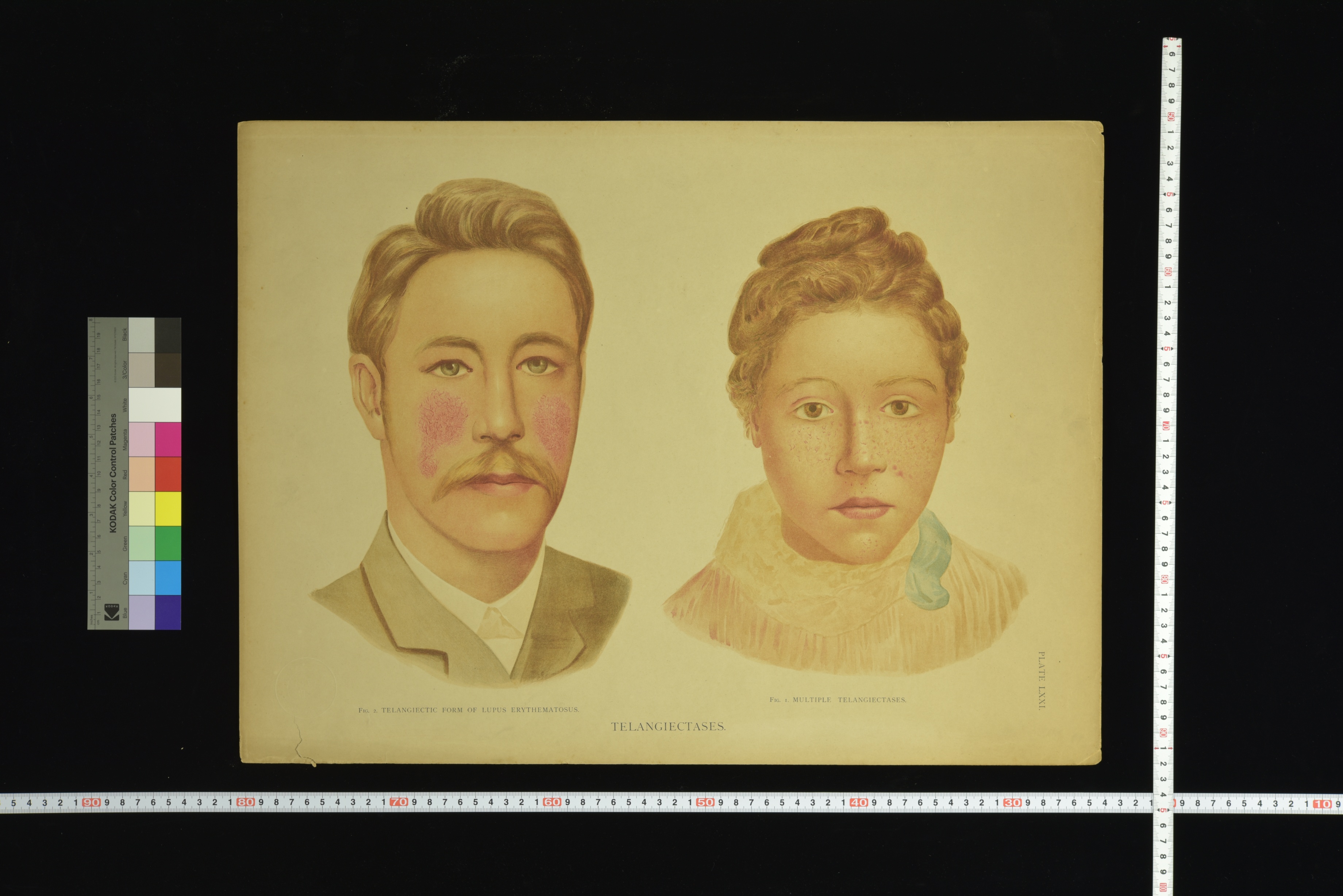 第8章 皮膚科学教室旧蔵皮膚病図譜 | 九州大学附属図書館