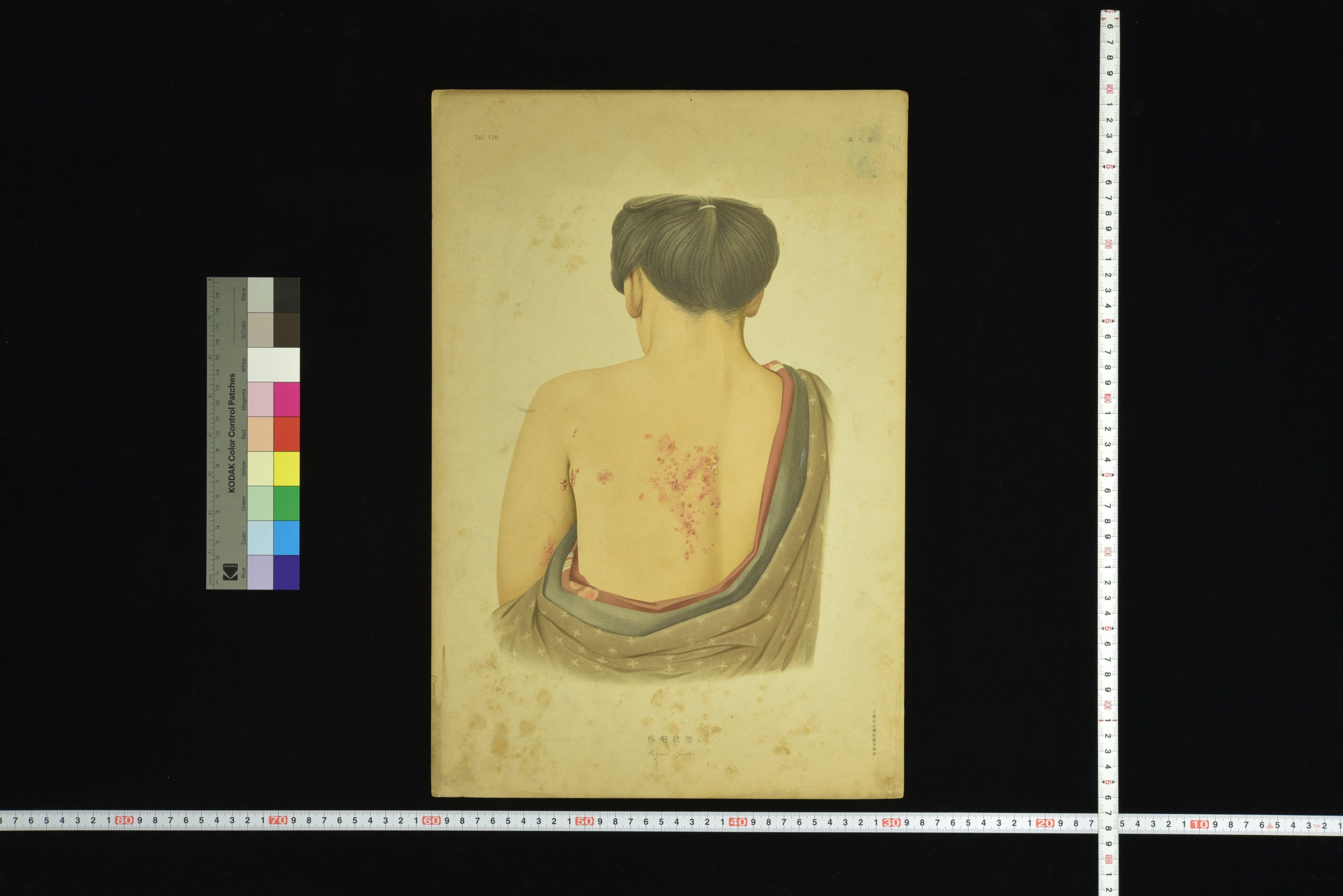 第8章 皮膚科学教室旧蔵皮膚病図譜 | 九州大学附属図書館