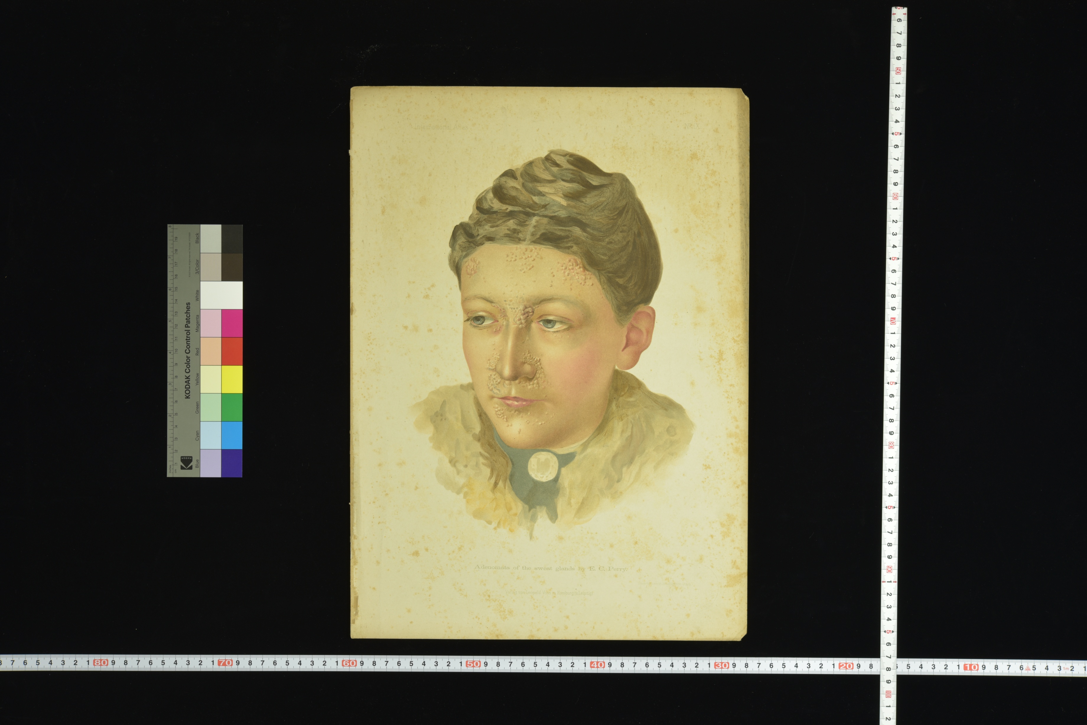 第8章 皮膚科学教室旧蔵皮膚病図譜 | 九州大学附属図書館