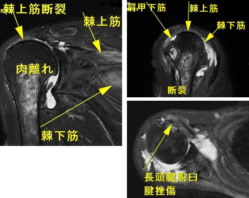 その他検査（関節・軟骨） 肩MRI | AIC八重洲クリニック