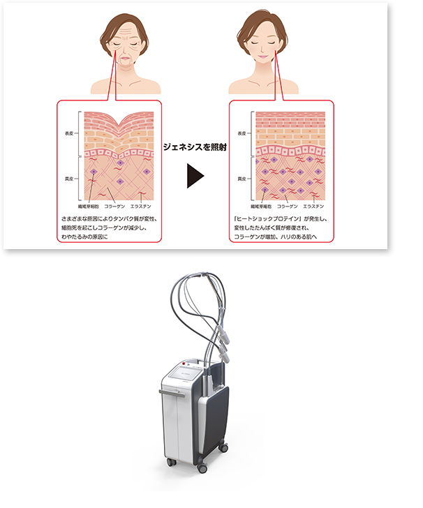 大阪でジェネシス「エクセルVプラスレーザー」 が9,900円【MA