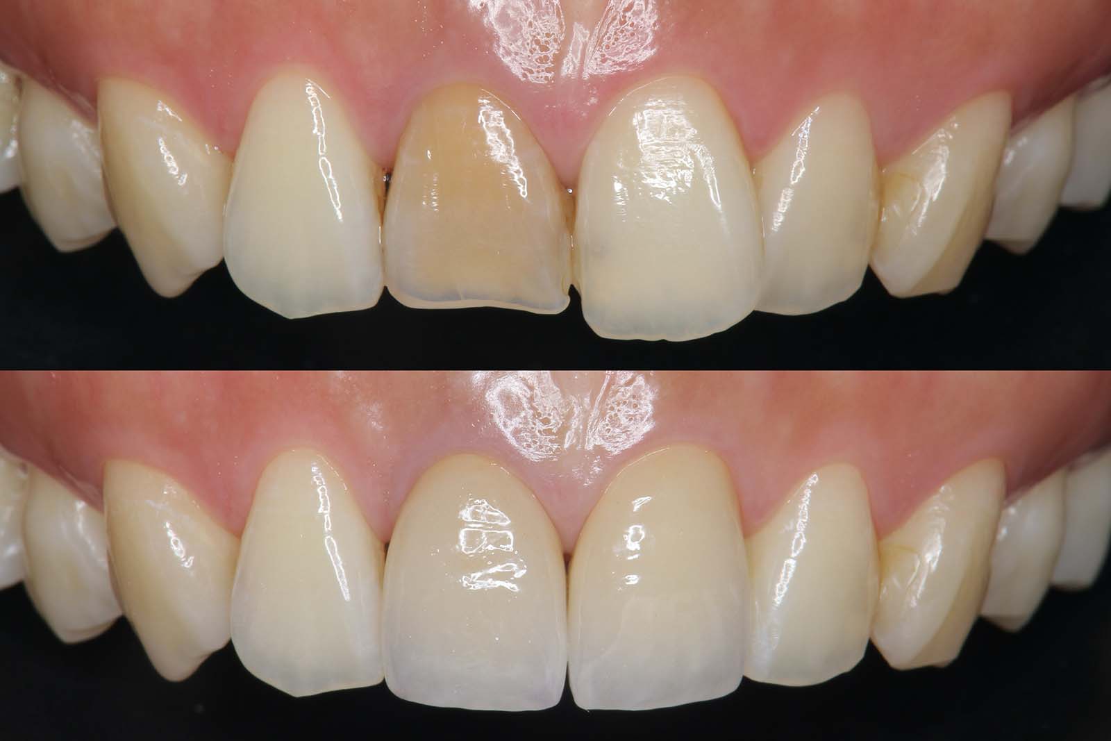 審美修復治療｜中津まさデンタルクリニック