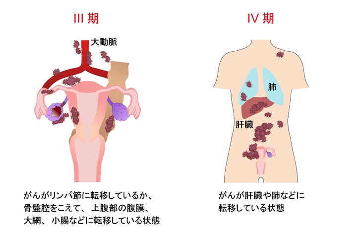 卵巣がんの治療について | 国立がん研究センター 東病院