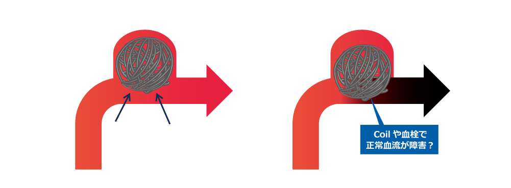 脳動脈瘤コイル塞栓術 | 流山中央病院 脳神経外科ページ