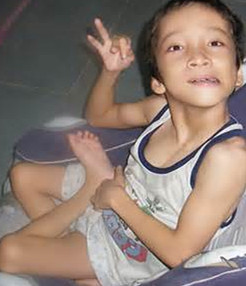 脳性麻痺の治療専門】脳性麻痺の治療なら中国鍼灸院｜脳性マヒと東洋