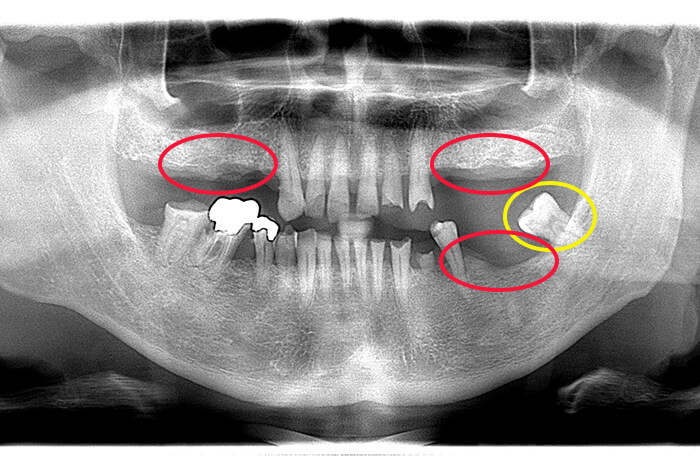 咬合再構成を含むインプラント｜横浜・町田でインプラント｜エス歯科