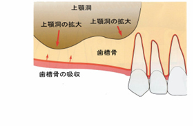 サイナスリフト｜患者様目線のやさしい歯医者 品川シーサイド歯科