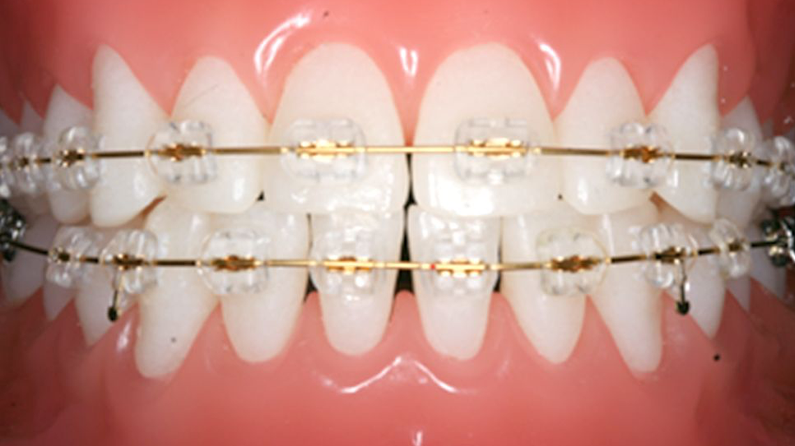 審美ブラケット｜自由が丘の歯医者 自由が丘シーズ歯科・矯正歯科