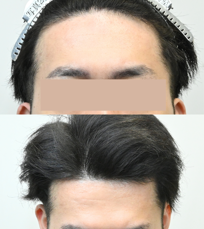 徹底解説】少ないグラフト数でM字改善！スリットが自毛植毛成功の鍵-20