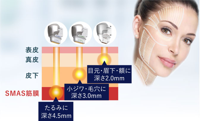 リフトアップ（ウルトラフォーマーⅢ）｜大阪府門真市・守口市の神道