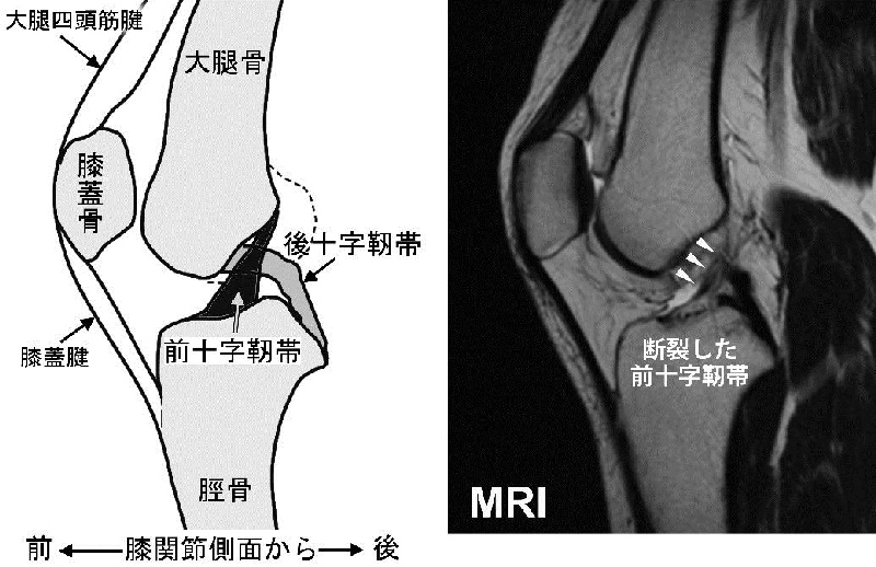 膝前十字靭帯再建術｜新札幌整形外科病院｜札幌市厚別区の整形外科