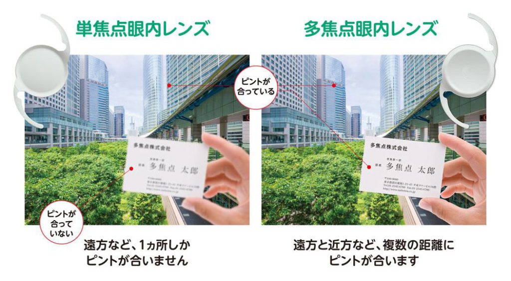 多焦点眼内レンズ - 鈴木眼科クリニック名東 - 名古屋市名東区の眼科