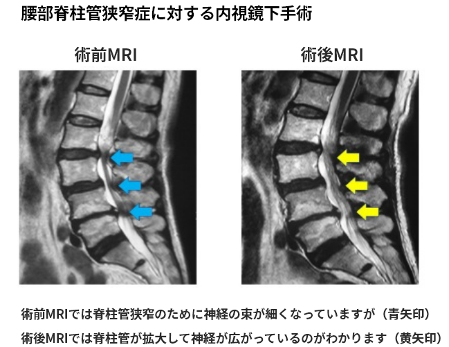 低侵襲手術：脊椎内視鏡下手術｜脊椎内視鏡、肩・股・膝の関節鏡・人工
