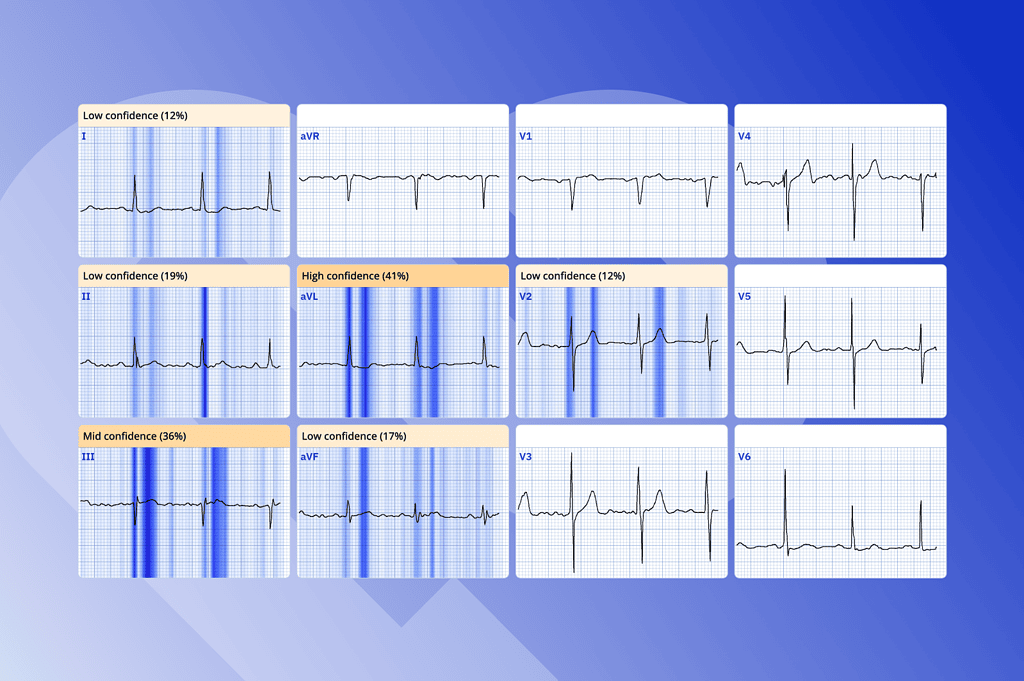 ECG Explainability in PMcardio: Human-Centered AI