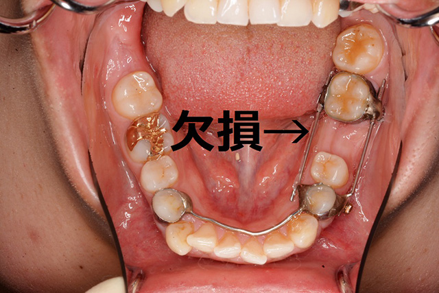 歯が足りない欠損歯と歯が多い過剰歯：横浜 プラージュ矯正歯科クリニック
