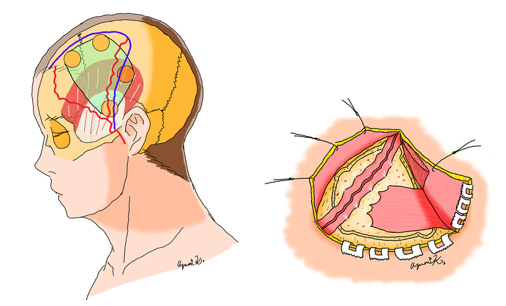もやもや病｜対象疾患と治療について｜脳神経機能外科学分野（脳神経