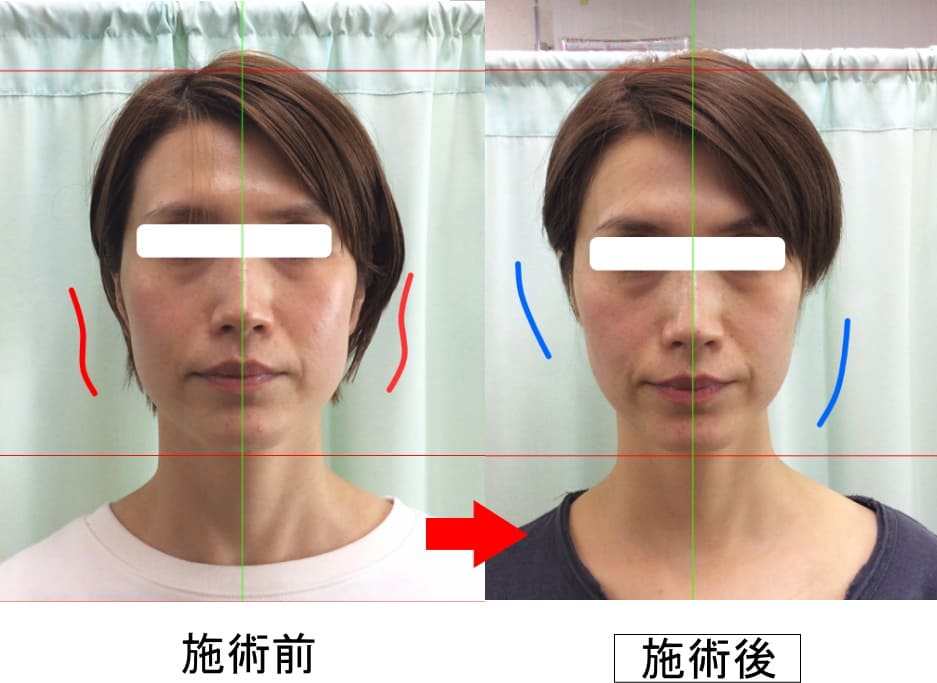 東北整体院 | 小顔矯正で、顔の歪み、左右差を改善し、小顔美人を