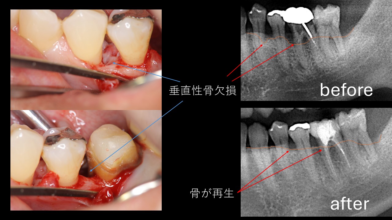 保険治療による歯周組織再生療法 |坂戸駅南口正面の歯医者「富士虎ノ門