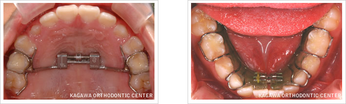 小児矯正における早期治療の意味 | は世界水準の治療を行います