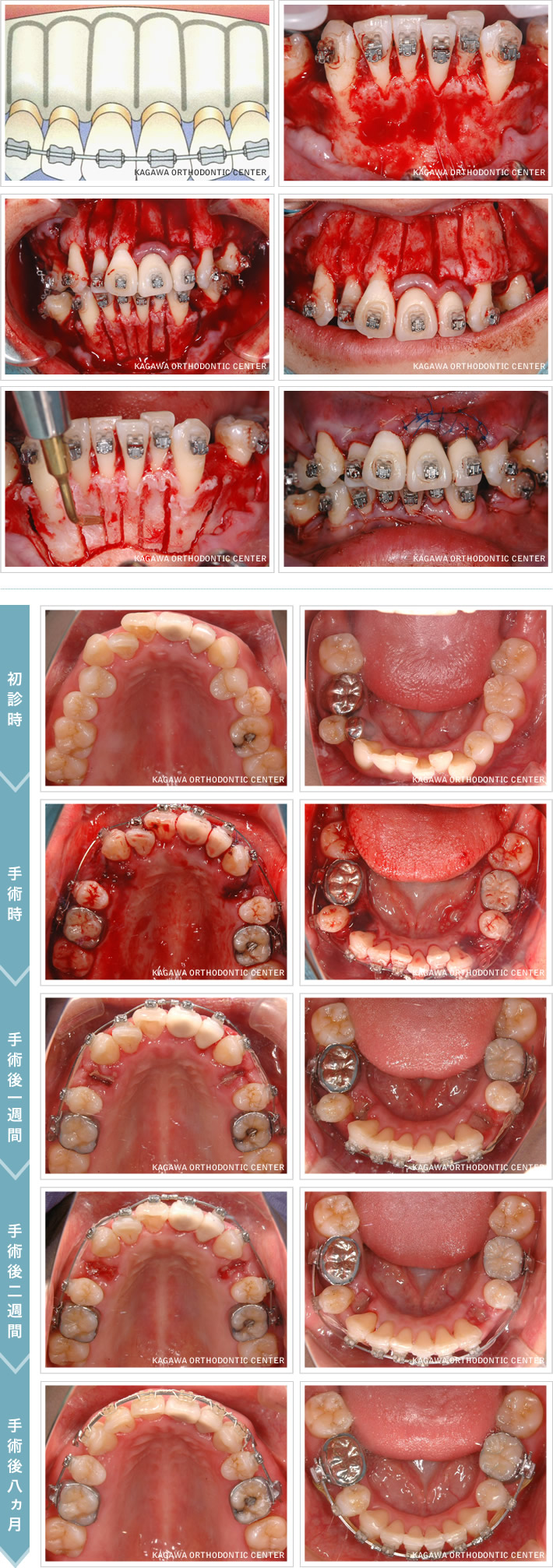 香川県の成人矯正治療はたくま歯科医院まで