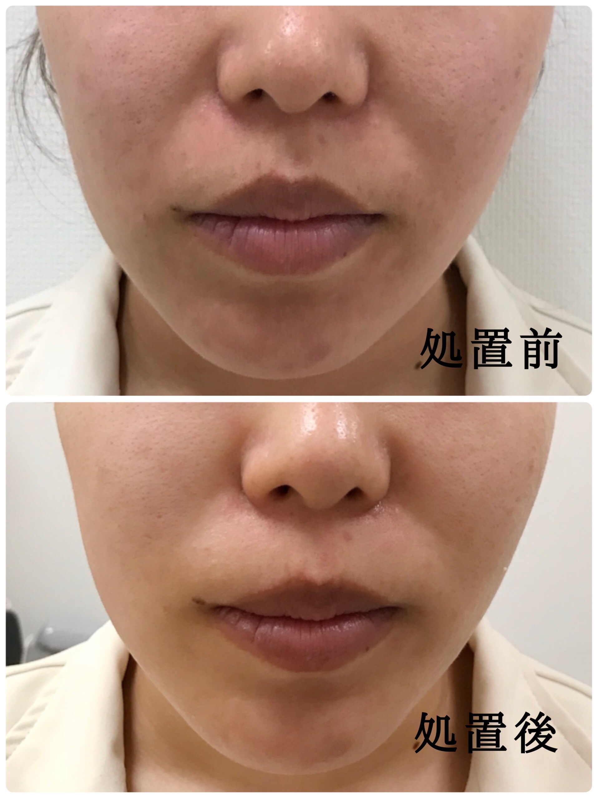 すぐに効果を実感！顔のたるみとほうれい線には、即効型の「ウルトラ