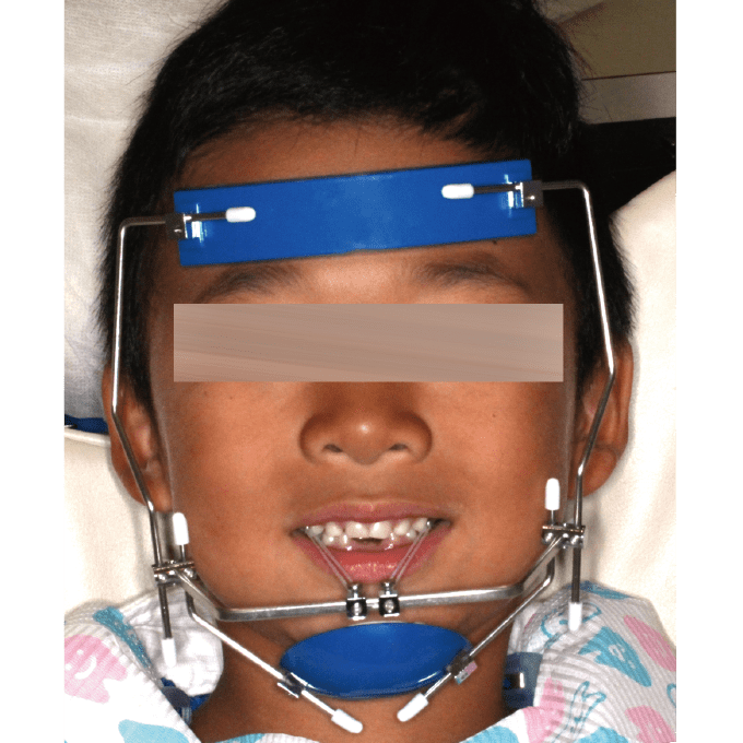 矯正歯科 こども顎顔面矯正 - 装置の種類について | 武庫之荘 井上歯科