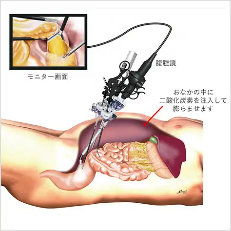 大腸の腹腔鏡下手術 | 医療法人 山下病院｜愛知県一宮市の消化器内科