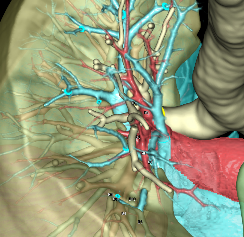 肺切除解析｜手術シミュレーション｜REVORAS