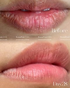 ローマピンク–エックスクリニック｜X CLINIC｜ エイジングケア・クマ