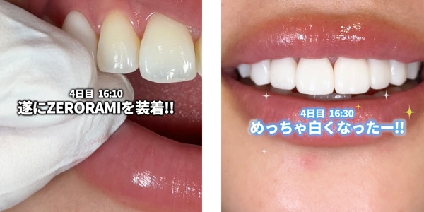 ZERO RAMI(ゼロラミ) – 歯を削らないセラミック(ラミネートベニア