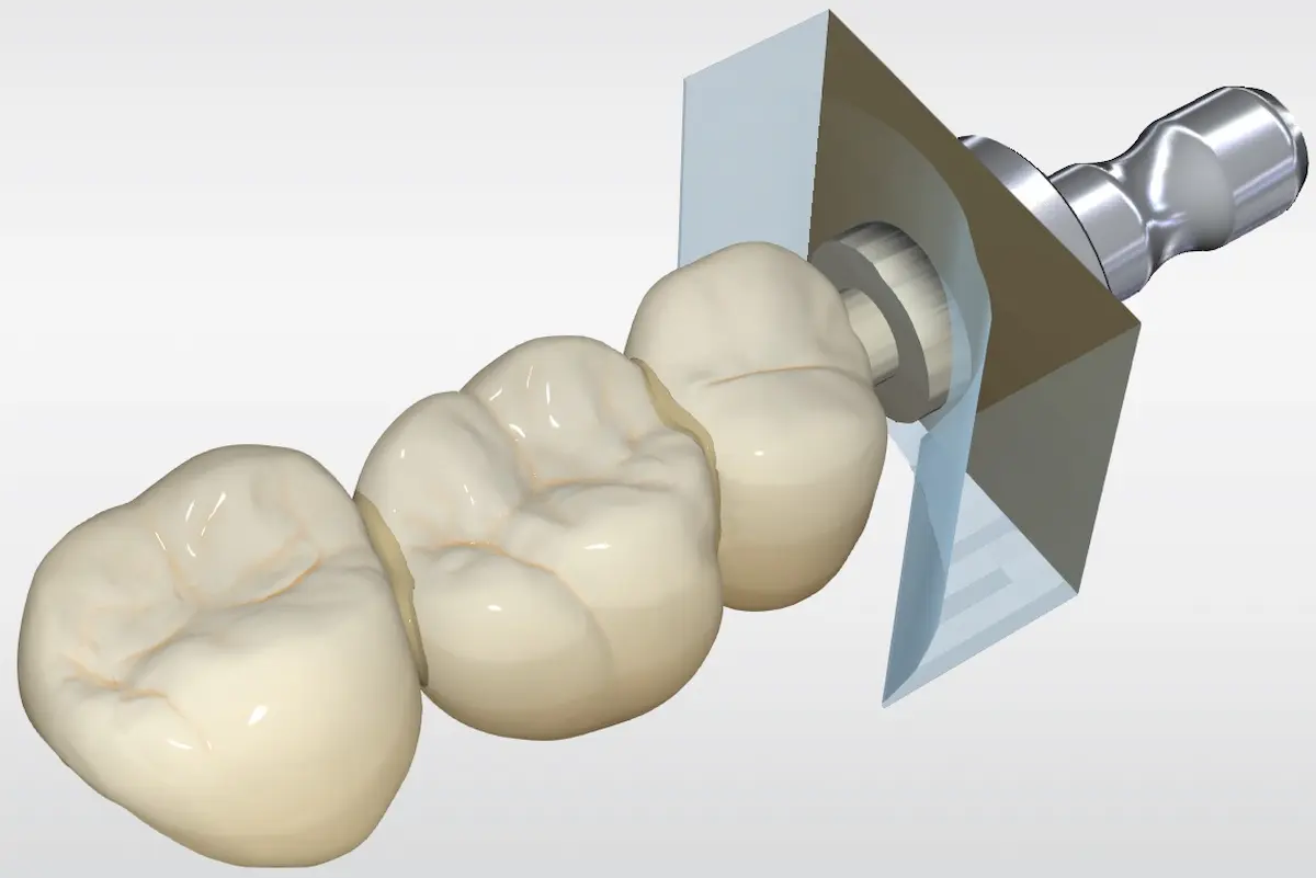 将来的に、CAD/CAMブリッジが保険収載されるかも？ | 八島歯科クリニック