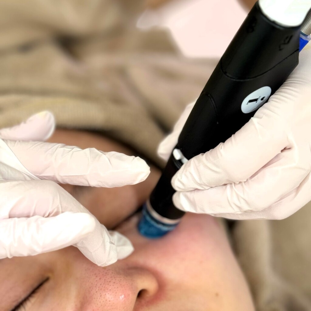 ハイドラフェイシャルを広島で受けよう！メンズにも注目される理由は？