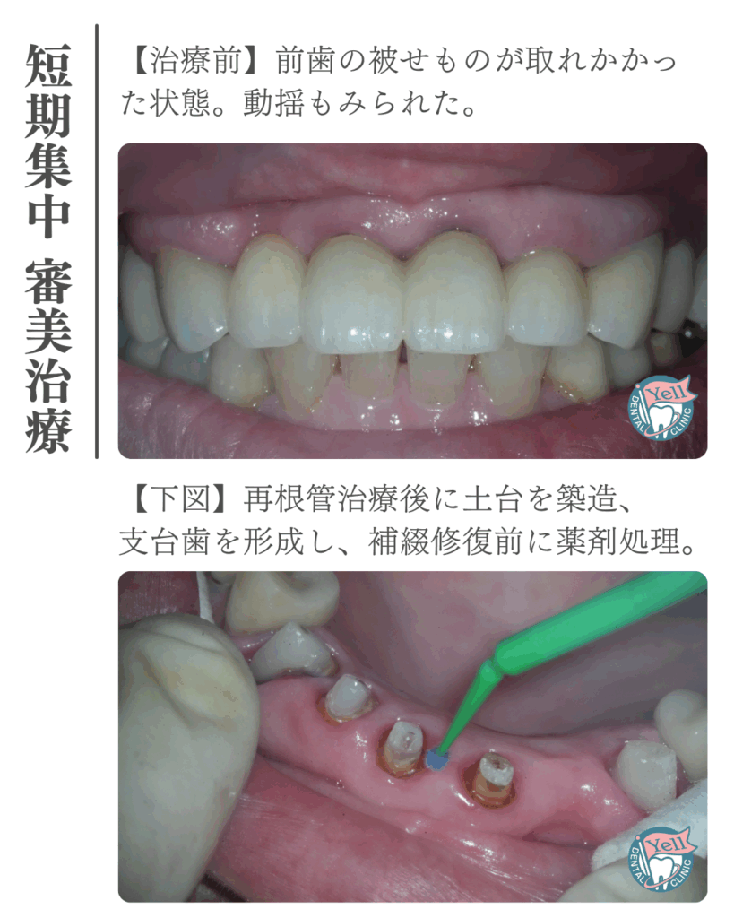 短期集中・審美歯科治療】アメリカ在住の患者さまの前歯6本＆臼歯
