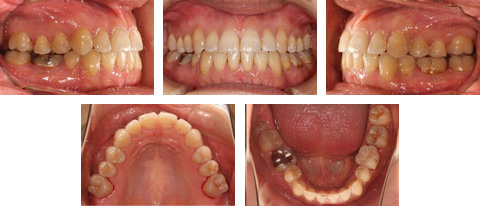 失敗矯正例5】途中なのに治療終了の宣告 - Yogosawa Foundation