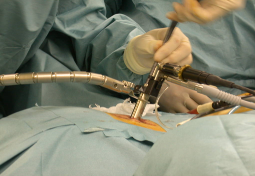 脊椎内視鏡手術について