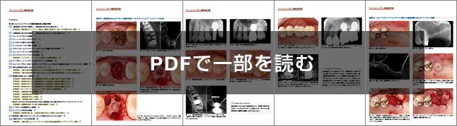ワイド・ショートインプラントの基礎と臨床 完全版 第5世代の