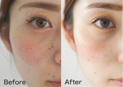 ✨️今だけ最安値最新型低周波シミ取りエステ✨️ ✨️最新型