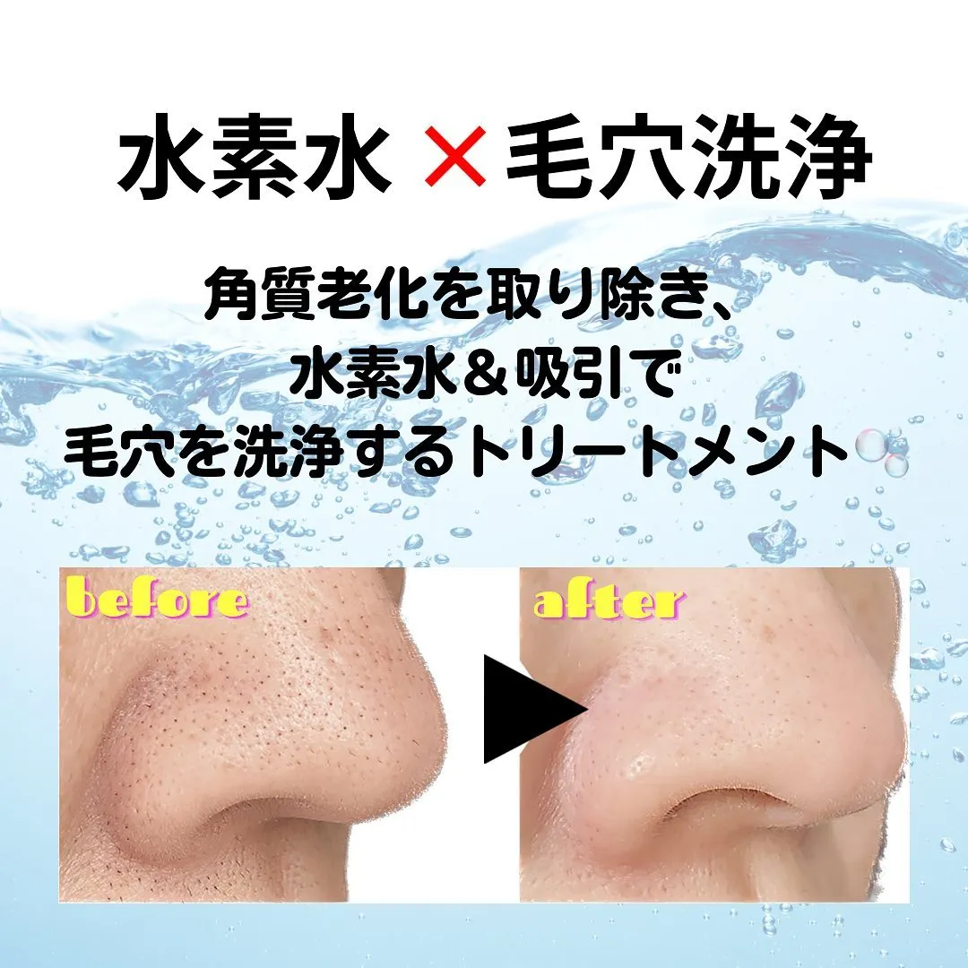 毛穴洗浄☆黒ずみ・ざらつき改善！ハイドロスプラッシュ | Blog | 大阪