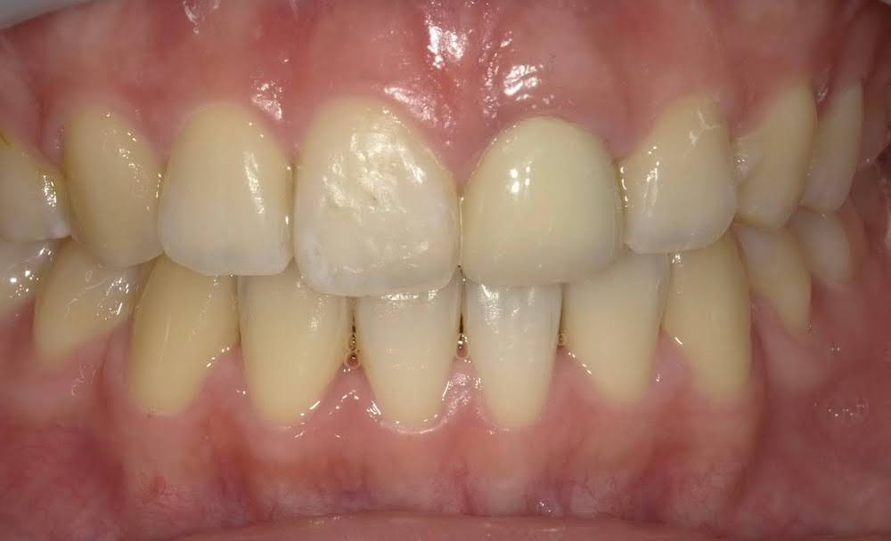 前歯のセラミックで失敗しない色と素材の選び方｜種類・費用・症例解説