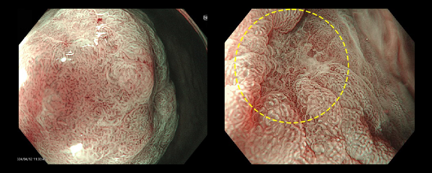 胃がん｜消化器｜診療内容｜医療法人 甘木第一クリニック
