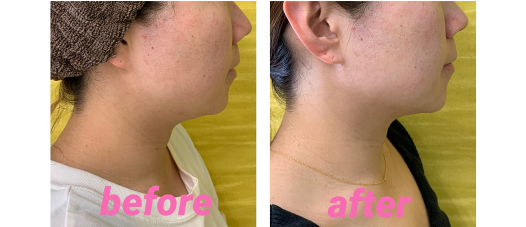 ウルトラ4Dハイフ|andC Beauty salon