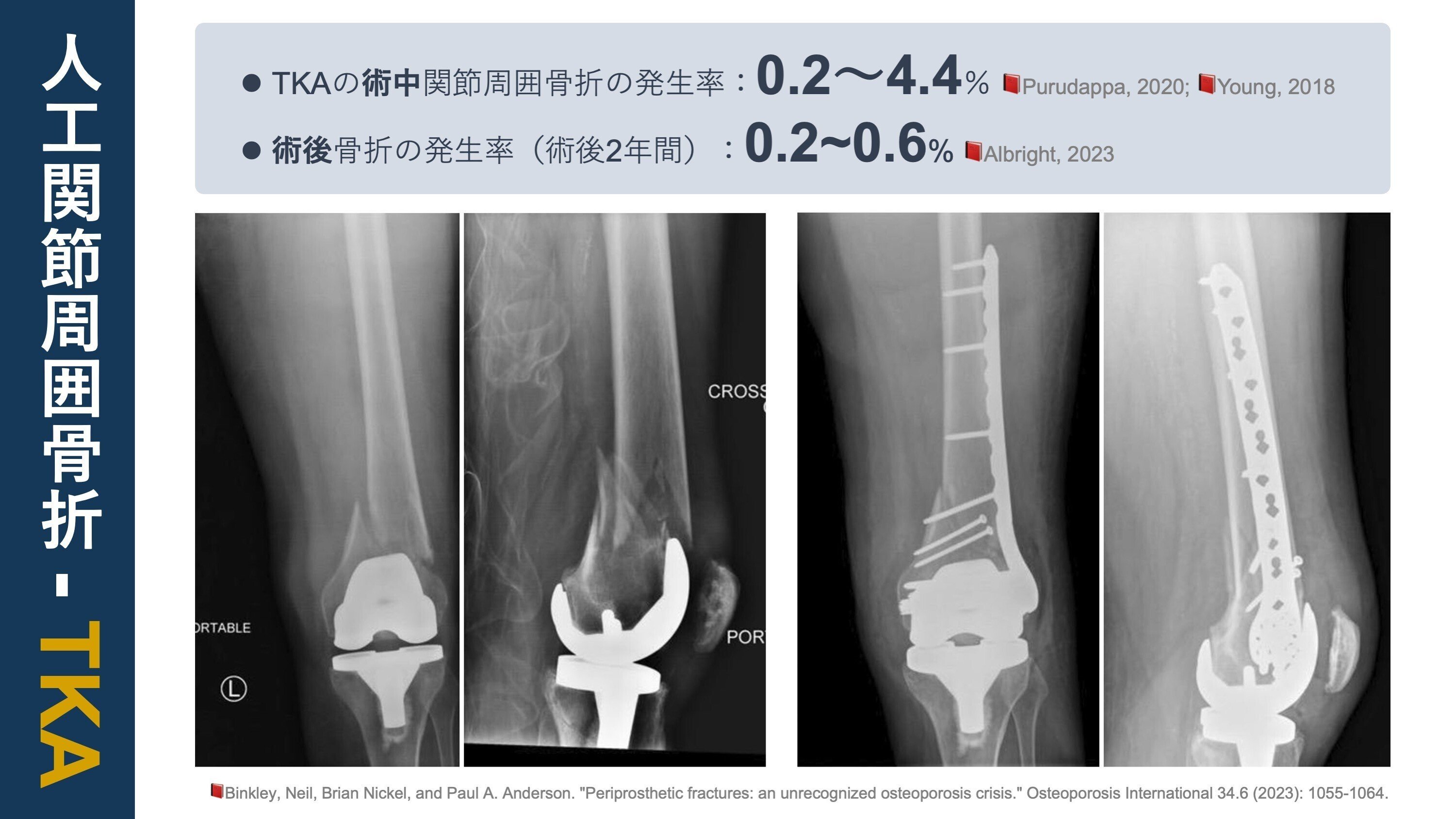 人工関節周囲骨折｜Super Human | 理学療法士／保健学博士 Ph.D.