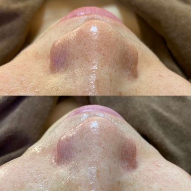 大阪堀江でハイドラフェイシャル】毛穴洗浄モニター様まだまだ募集中